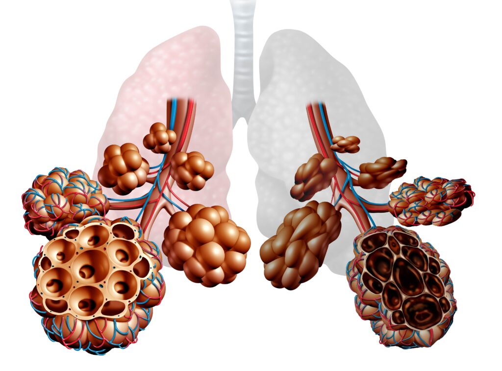 Strategies for managing chronic obstructive pulmonary disease