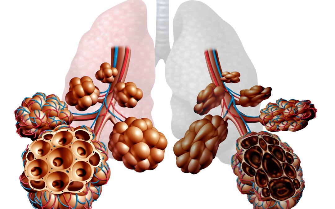 Strategies for managing chronic obstructive pulmonary disease